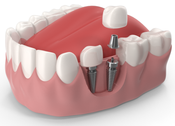 Імплантація зубів у Броварах - клініка імплантології зубів | Мрия